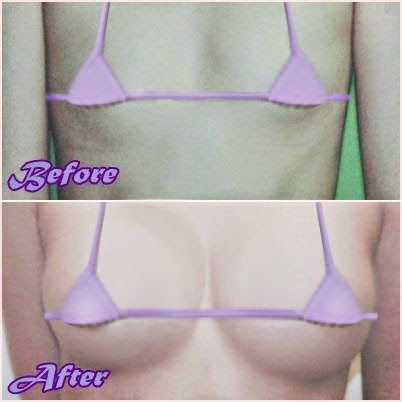 Breast Augmentation Surgery in Pune Breast Enlargement Surgery