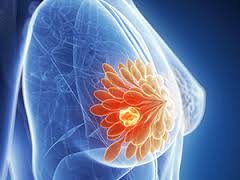 Breast Cancer Treatment in Pune - Dr. Anupama Mane