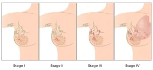 Staging-of-cancer