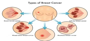 Types-of-breast-cancer