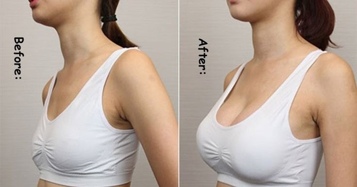 Breast augmentation surgery Pune results
